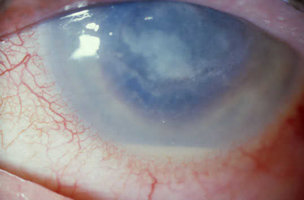 keratitis.jpg