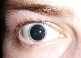 Mydriase_prononcée_2006.jpg